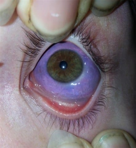 Is it safe to get your eyeballs inked? The risk of sclera tattoos explained  - Daily Star